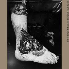 SommerFUntitled(Amputed Foot) .jpeg